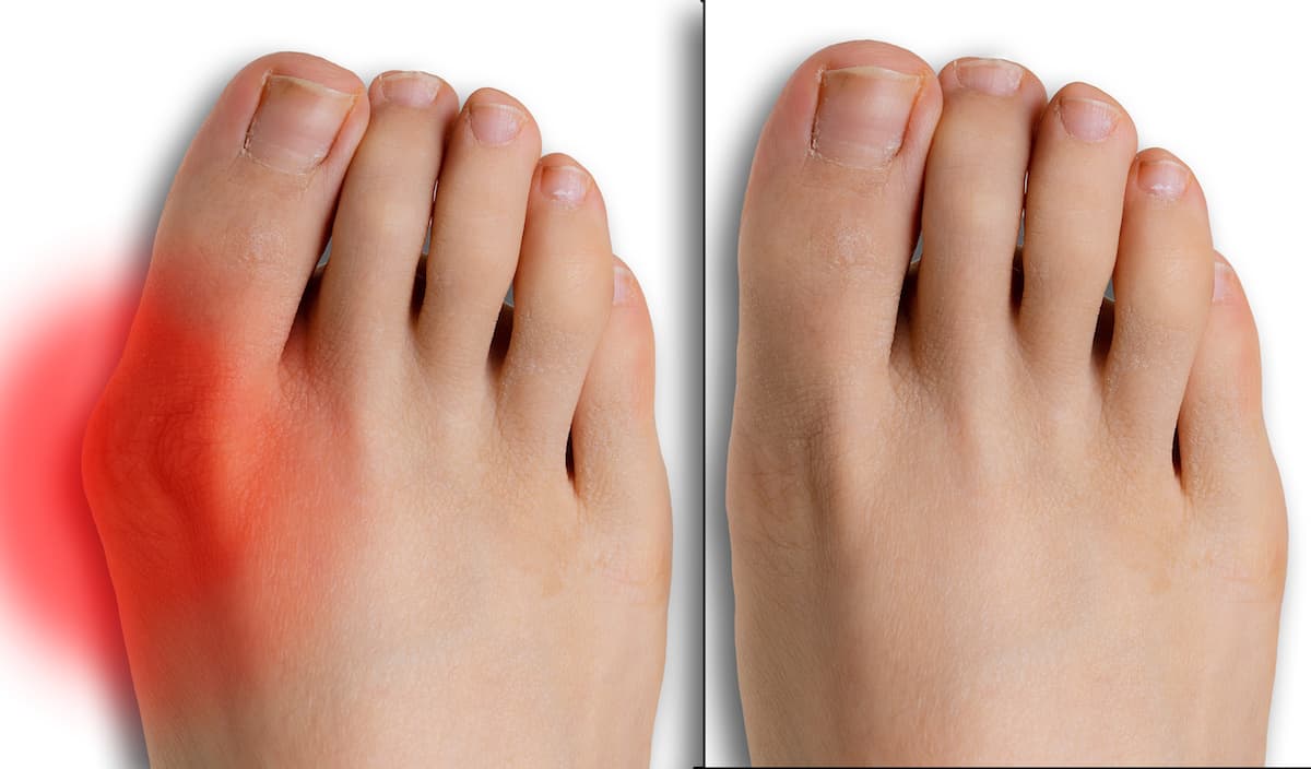 Bunion toe next to a normal toe