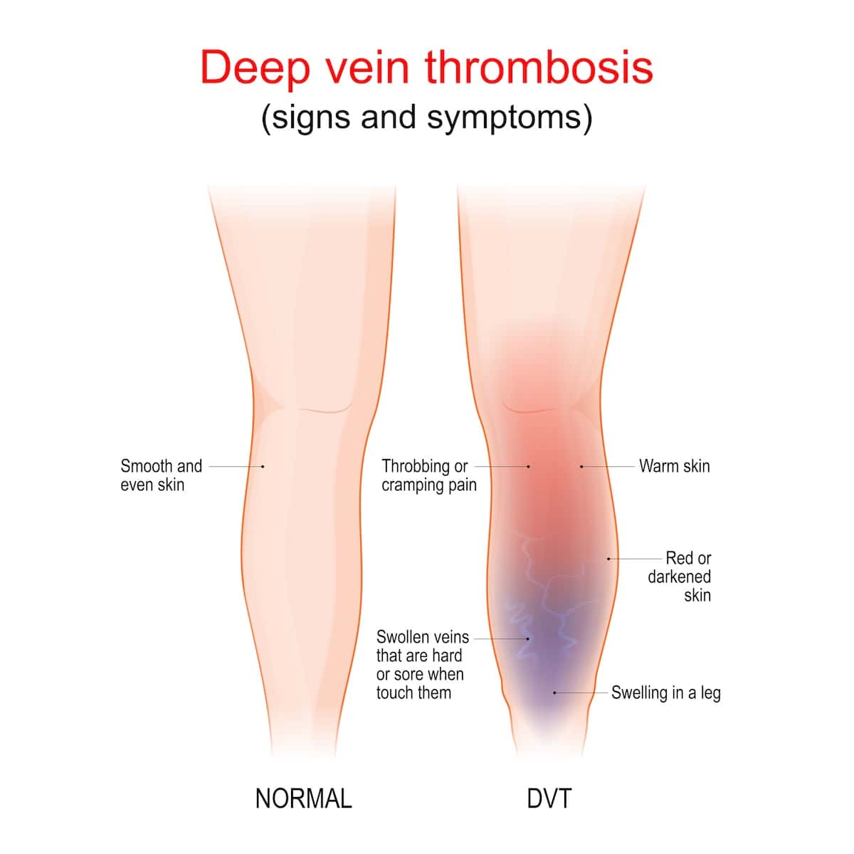 Signs and symptoms of DVT