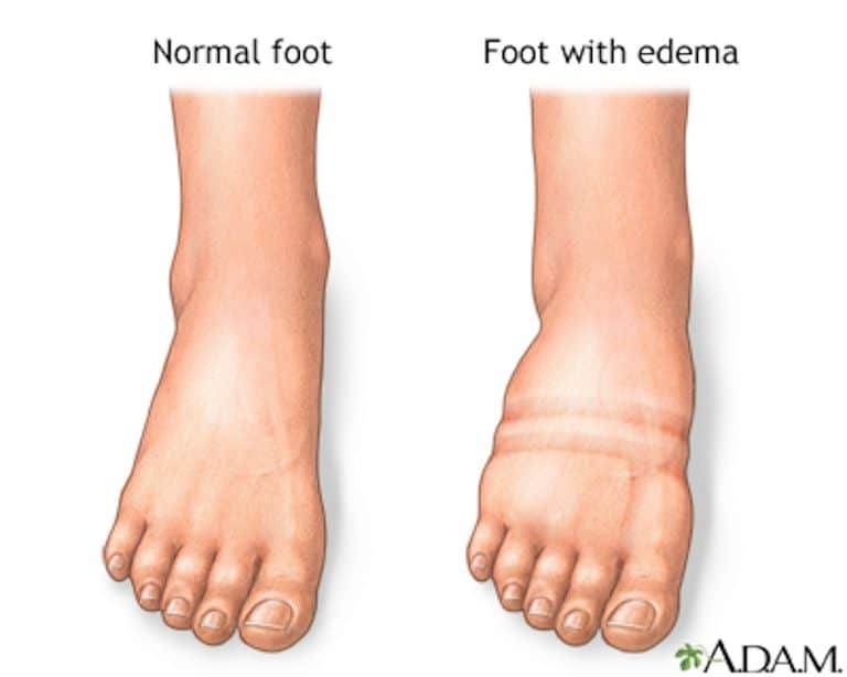 Swollen Ankles When Flying: 8 Questions and Answers