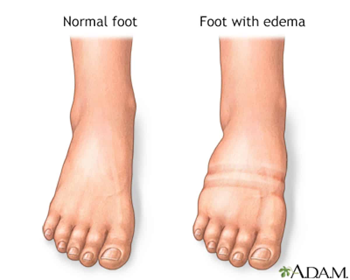 Normal and Swollen Foot